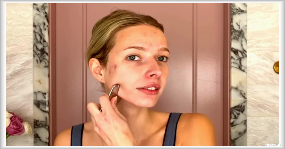 L'acné chez la Génération Z : entre enjeux de santé et pression sociale à l'ère des réseaux sociaux