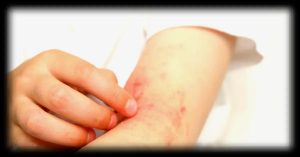 Allergies improbables : 5 cas surprenants qui peuvent surgir au quotidien