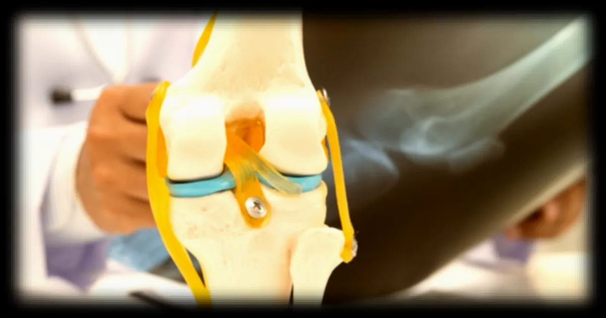 Arthrose du genou : la méniscectomie partielle arthroscopique remise en cause par une étude de dix ans