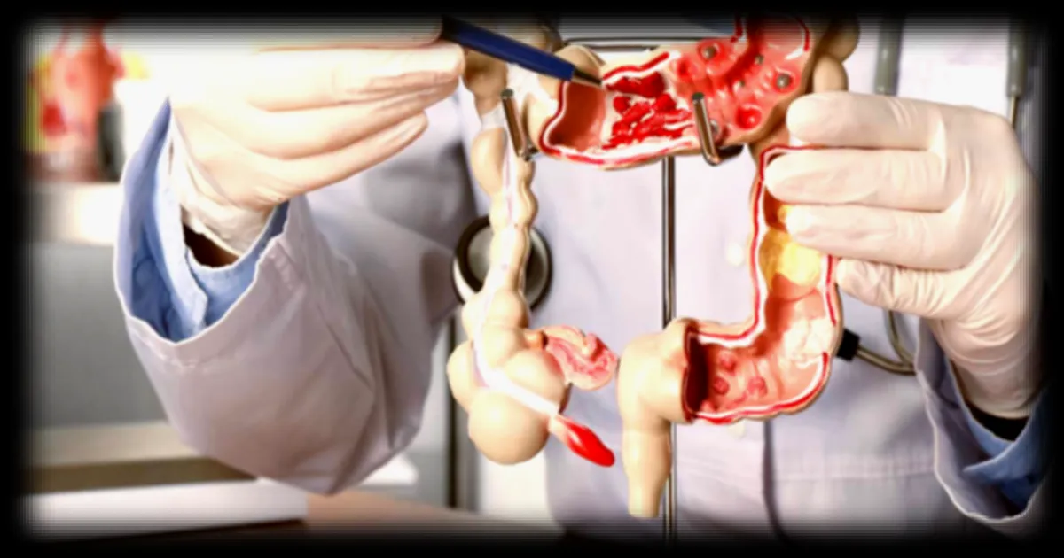 Cancer colorectal : le dépistage est-il encore tabou ? Une étude met en lumière l'intérêt des stratégies de dépistage pour prévenir ce cancer meurtrier.