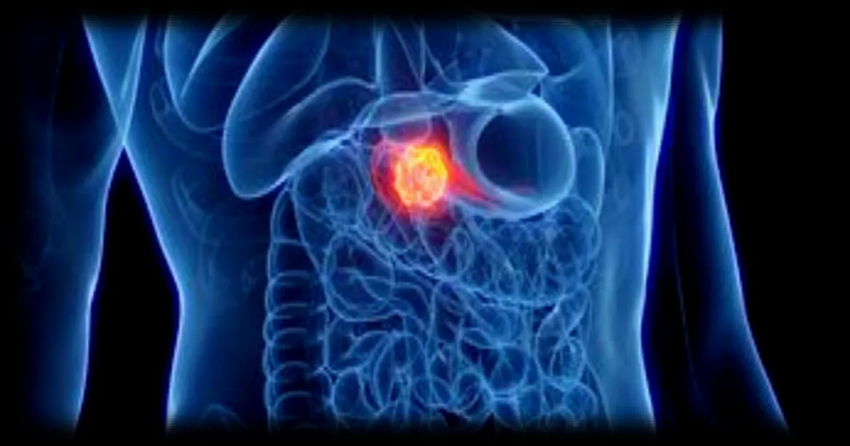 Cancer du pancréas : le daraxonrasib, un nouveau traitement qui double l’espérance de vie, suscite l’espoir