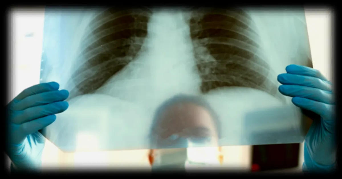 Cancer du poumon : les signaux d'alerte insidieux qui viennent du foie