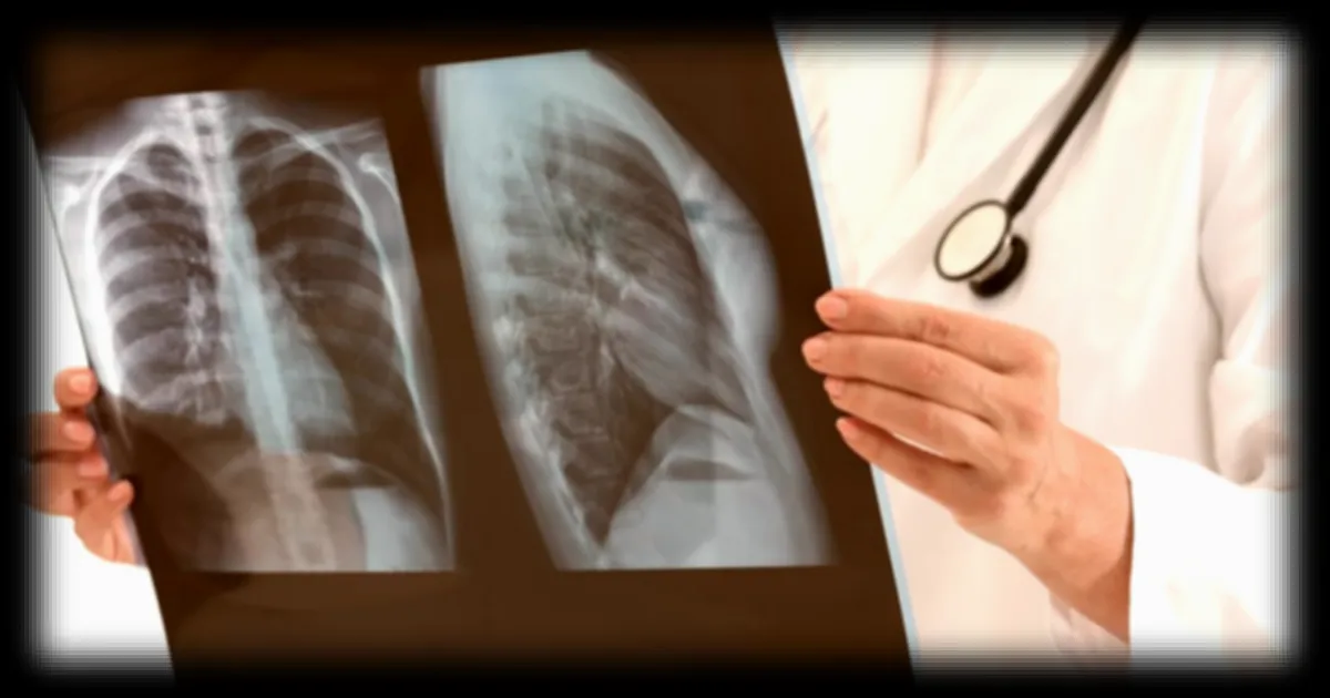 Cancer du poumon : un programme pilote de dépistage gratuit lancé dans cinq régions françaises