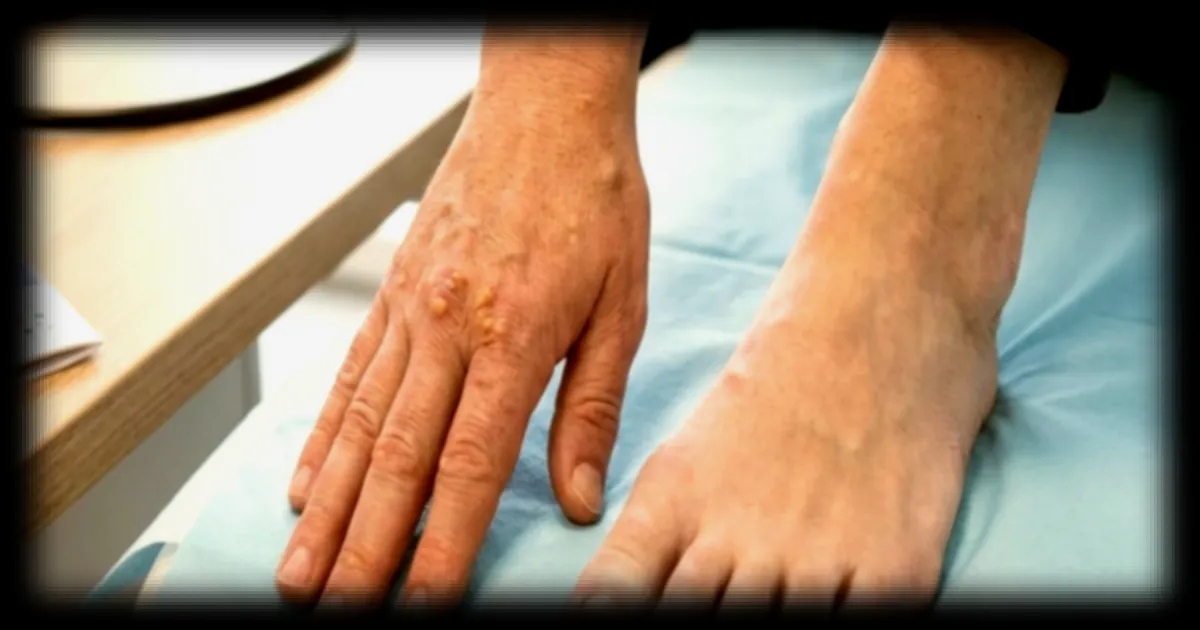 Cholestérol élevé : les signes méconnus sur les mains et les pieds à ne pas ignorer