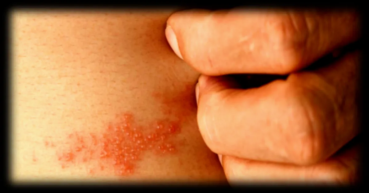 Complication rare : la vessie d'un patient se rompt suite à un zona, un cas inhabituel rapporté par des médecins