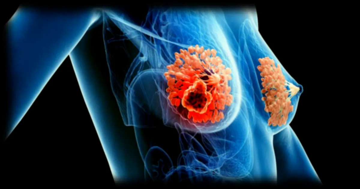 Découverte d'un lien entre les bactéries intestinales et le cancer du sein