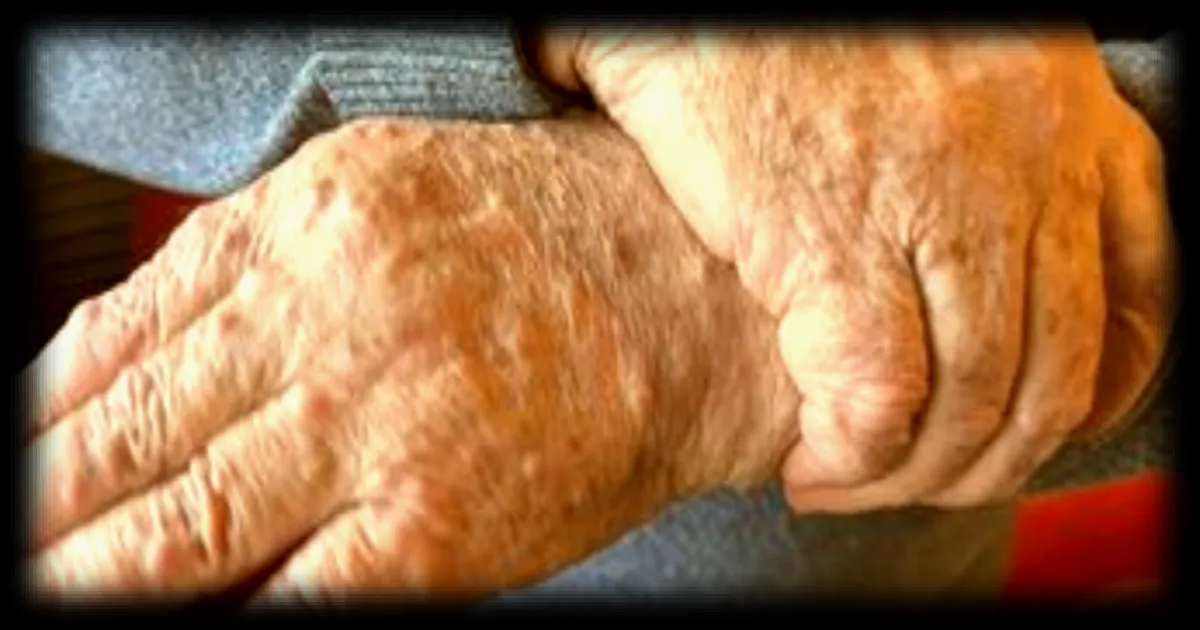 Des altérations du microbiote spécifiques à la maladie de Parkinson découvertes dans une étude internationale