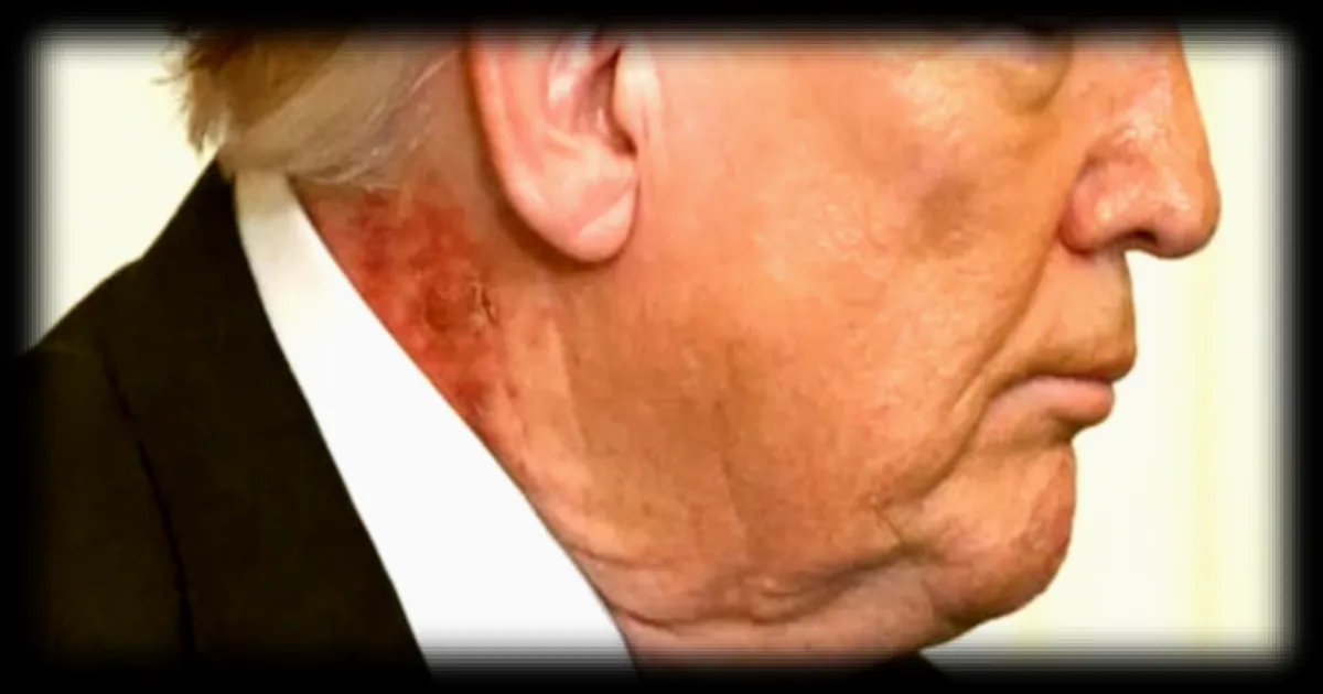 Donald Trump apparaît avec une plaque rougeâtre dans le cou: son médecin clarifie la situation
