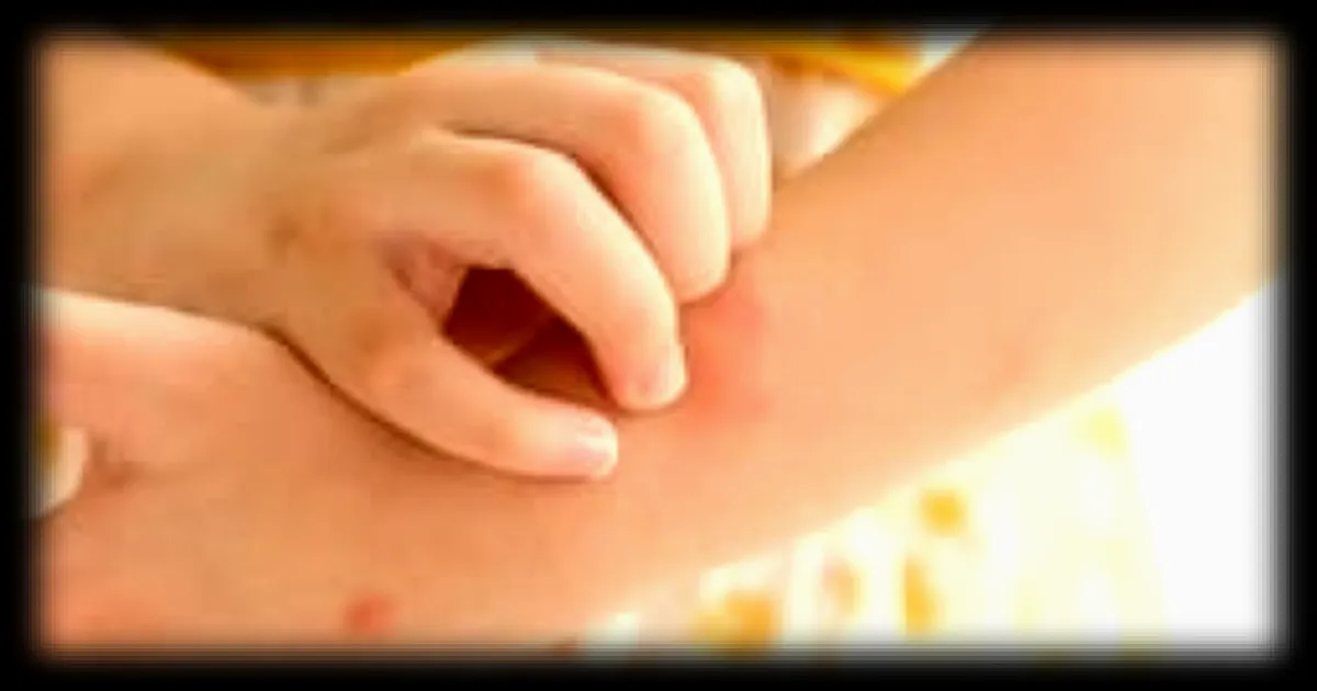 Eczéma atopique : conseils pour la période estivale