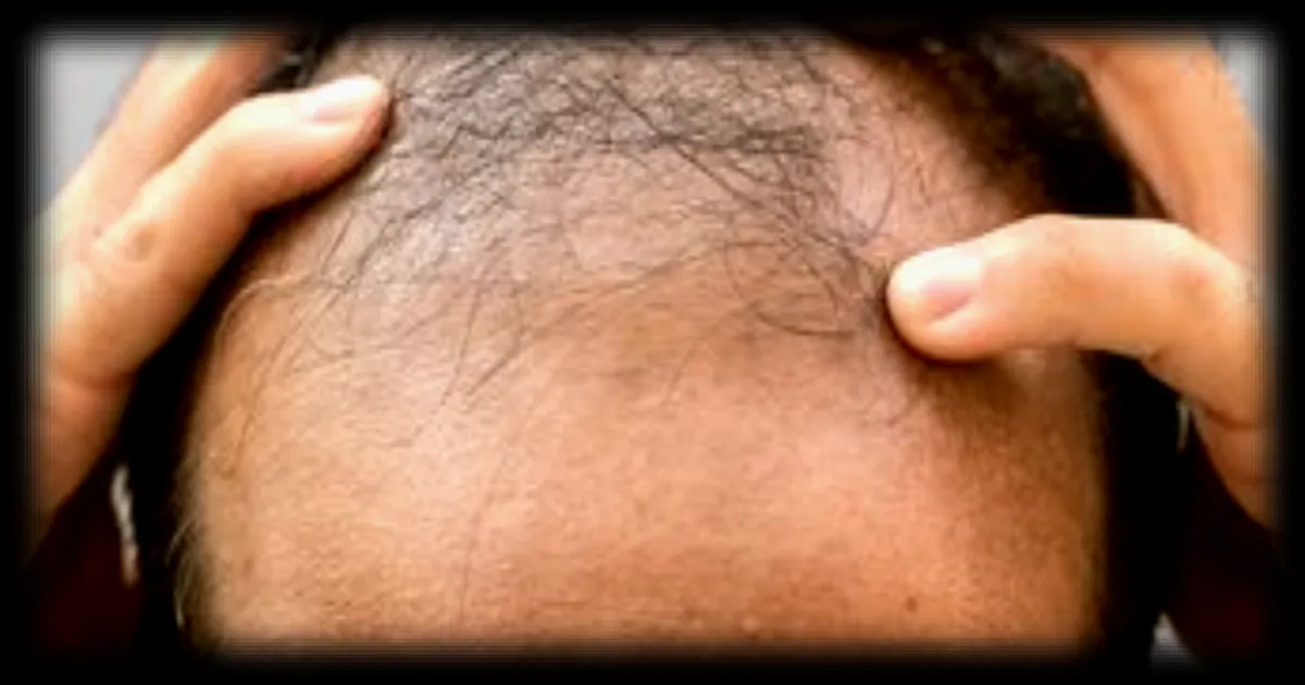 Finastéride : une attestation obligatoire dès le 16 avril pour les traitements contre la calvitie