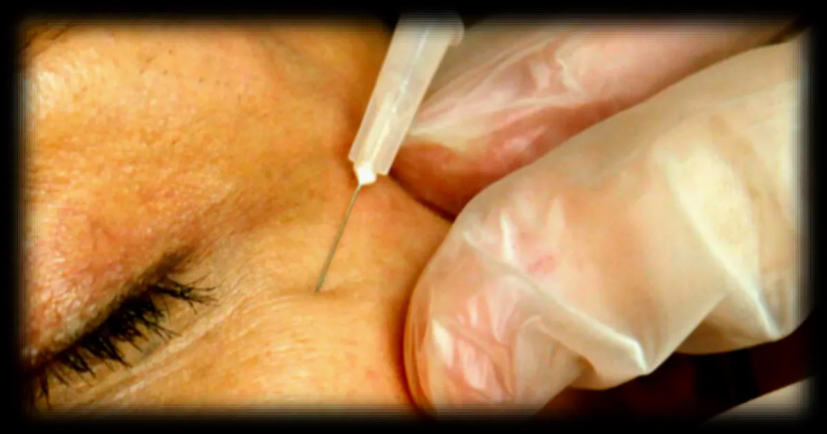 Irlande : la tendance des injections de botox chez les jeunes femmes