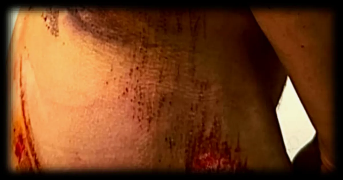 Les blessures de Michal Kwiatkowski suite à sa chute lors de Milan San Remo