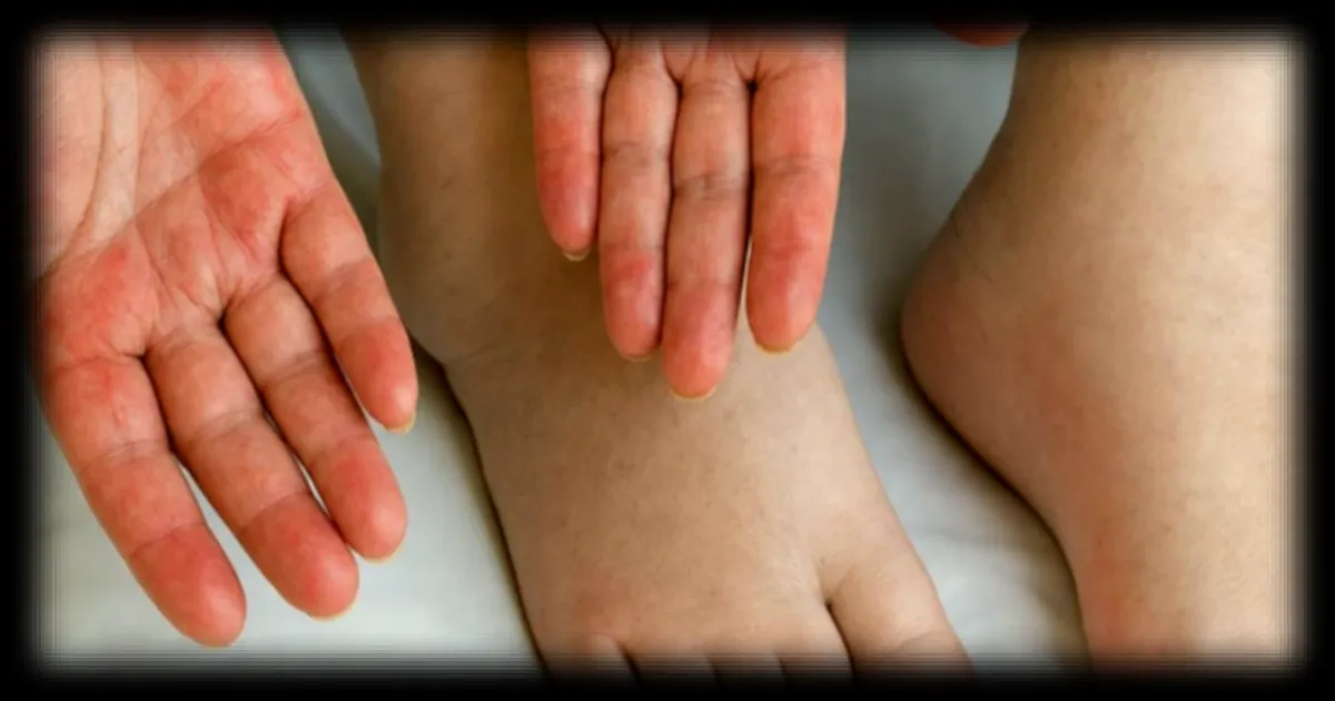 Les signes visibles sur les mains et les pieds qui peuvent alerter sur une maladie du foie