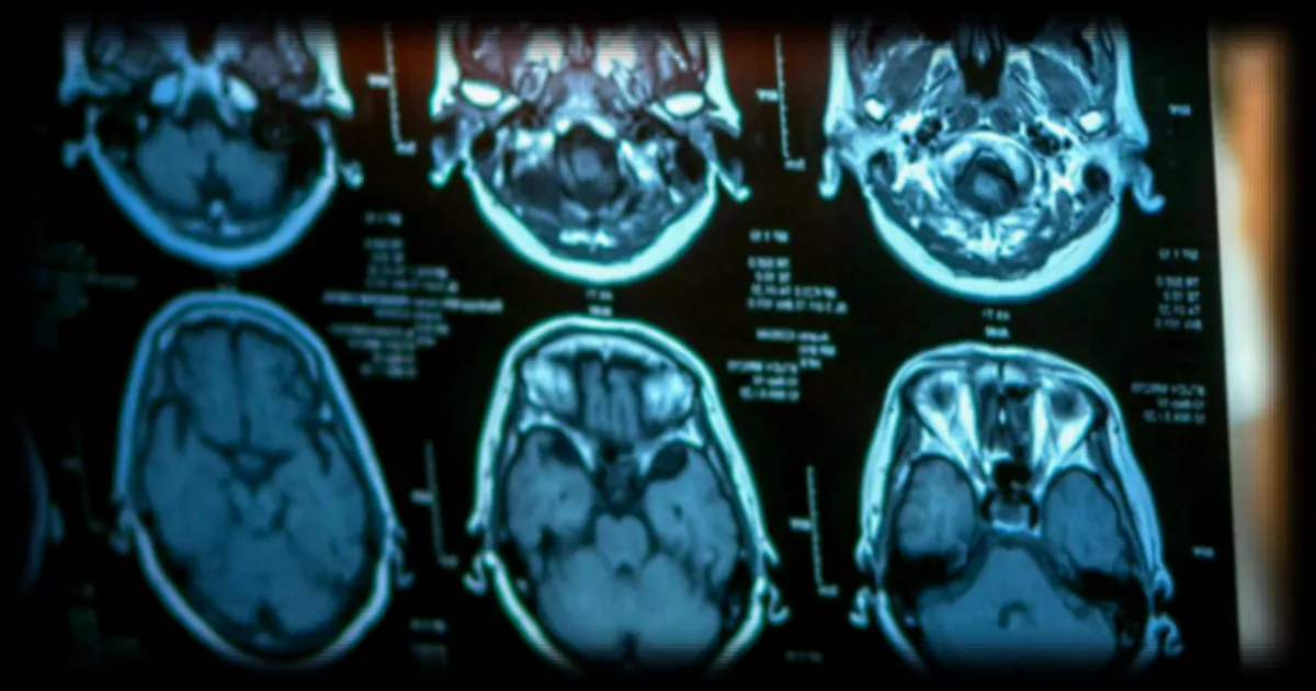Maladie d'Alzheimer : une étude révèle le rôle clé des microgliocytes dans son développement