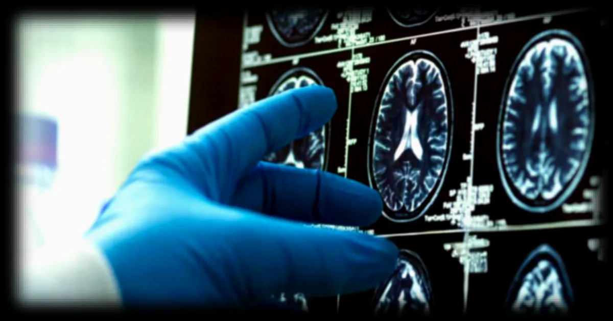 Microplastiques dans le cerveau humain : une étude alerte sur leur accumulation alarmante