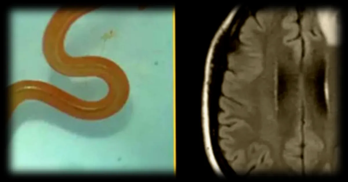 Parasite inédit découvert chez l'humain : un ver de python retrouvé dans le cerveau d'une patiente australienne
