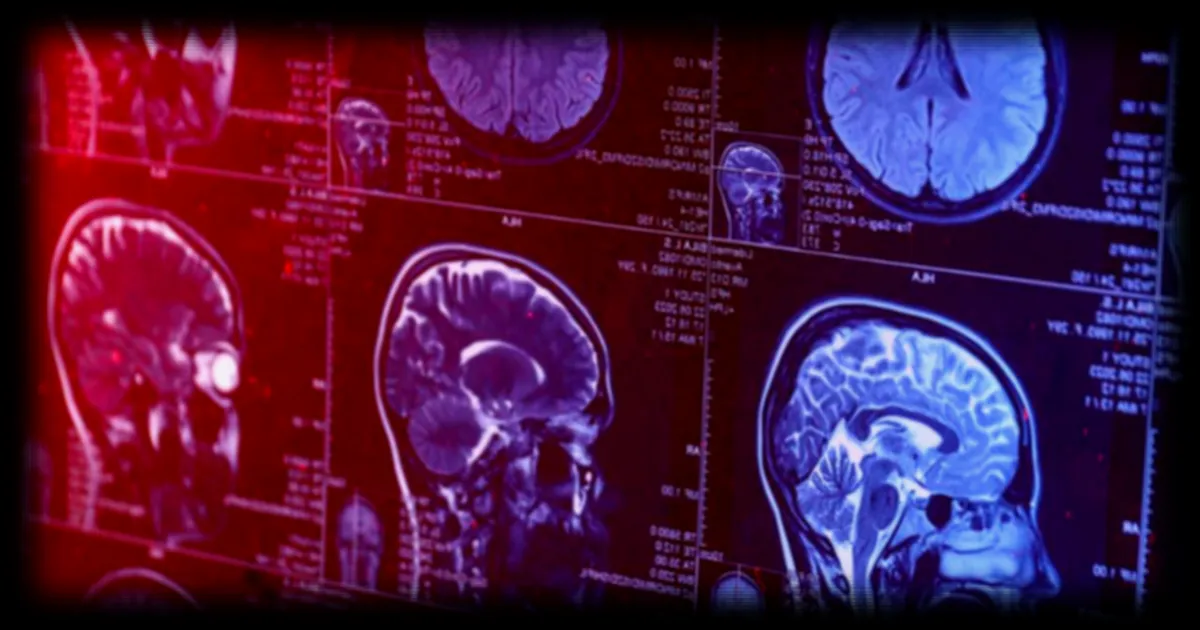 Un cas exceptionnel : un jeune Chinois de 19 ans diagnostiqué Alzheimer, bouleversant les connaissances médicales