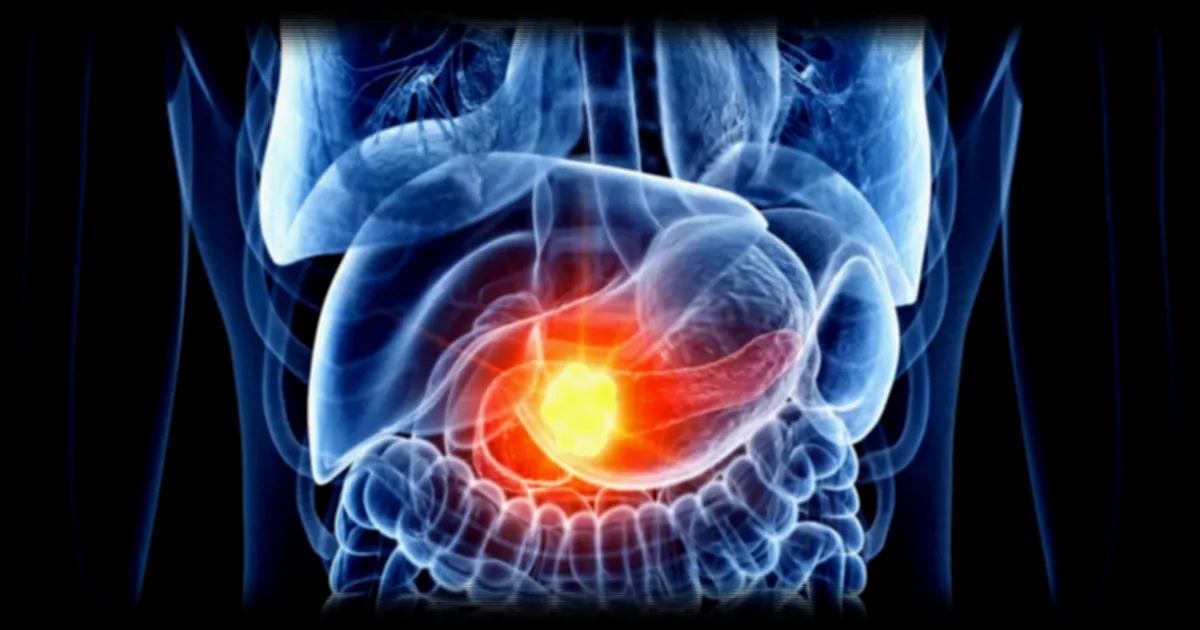 Un espoir majeur dans le traitement du cancer du pancréas : un nouveau médicament double la survie des patients à un an