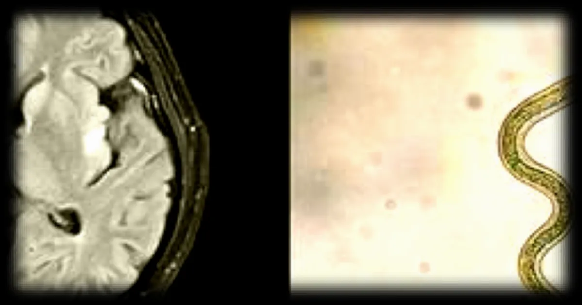 Un ver de 8 cm découvert dans le cerveau d'une patiente après une année de recherches médicales