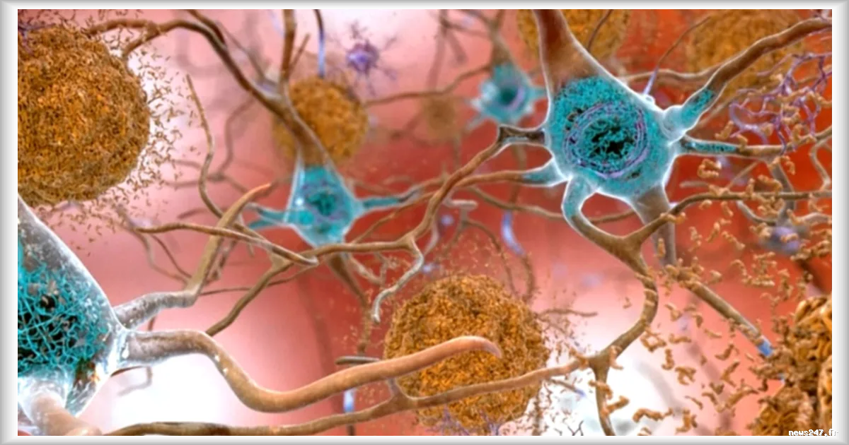 Test sanguin précoce pour Alzheimer : une avancée prometteuse, mais des limites persistantes