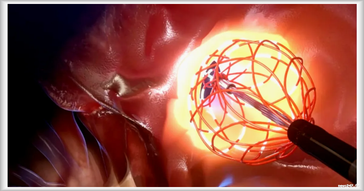 Un cathéter innovant pour révolutionner le traitement de l'arythmie